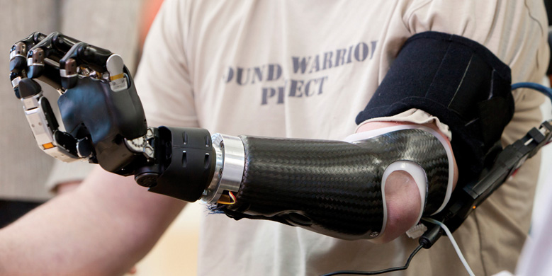 Discover the High-Fidelity Interface (HiFi) for Prosthetic Sockets in Fort Myers